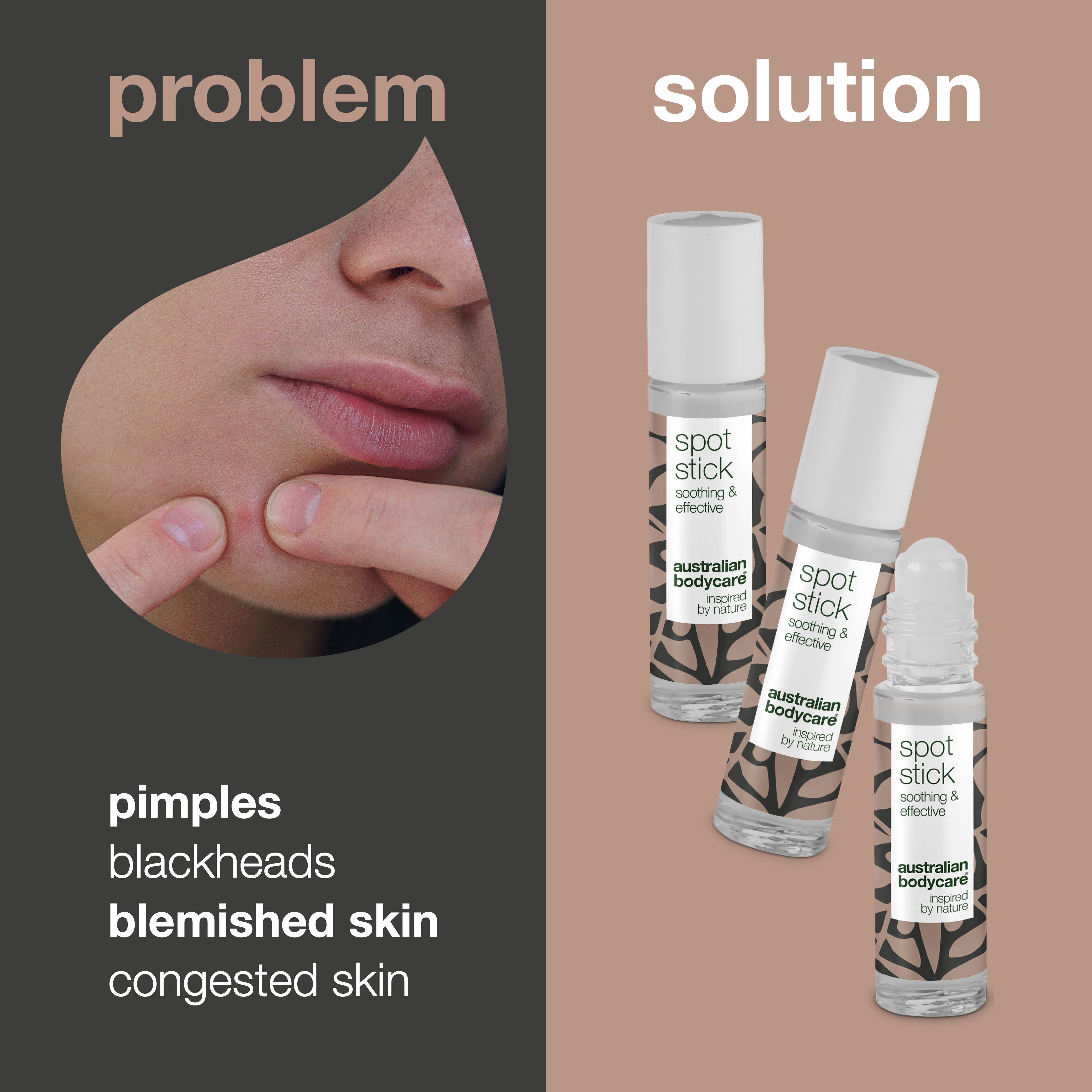 Sivilce ve siyah noktalar için 3’lü leke stick seti — sivilceye eğilimli ciltte noktasal uygulama ile kusur ve siyah nokta görünümünü hedef alan pratik bakım seti