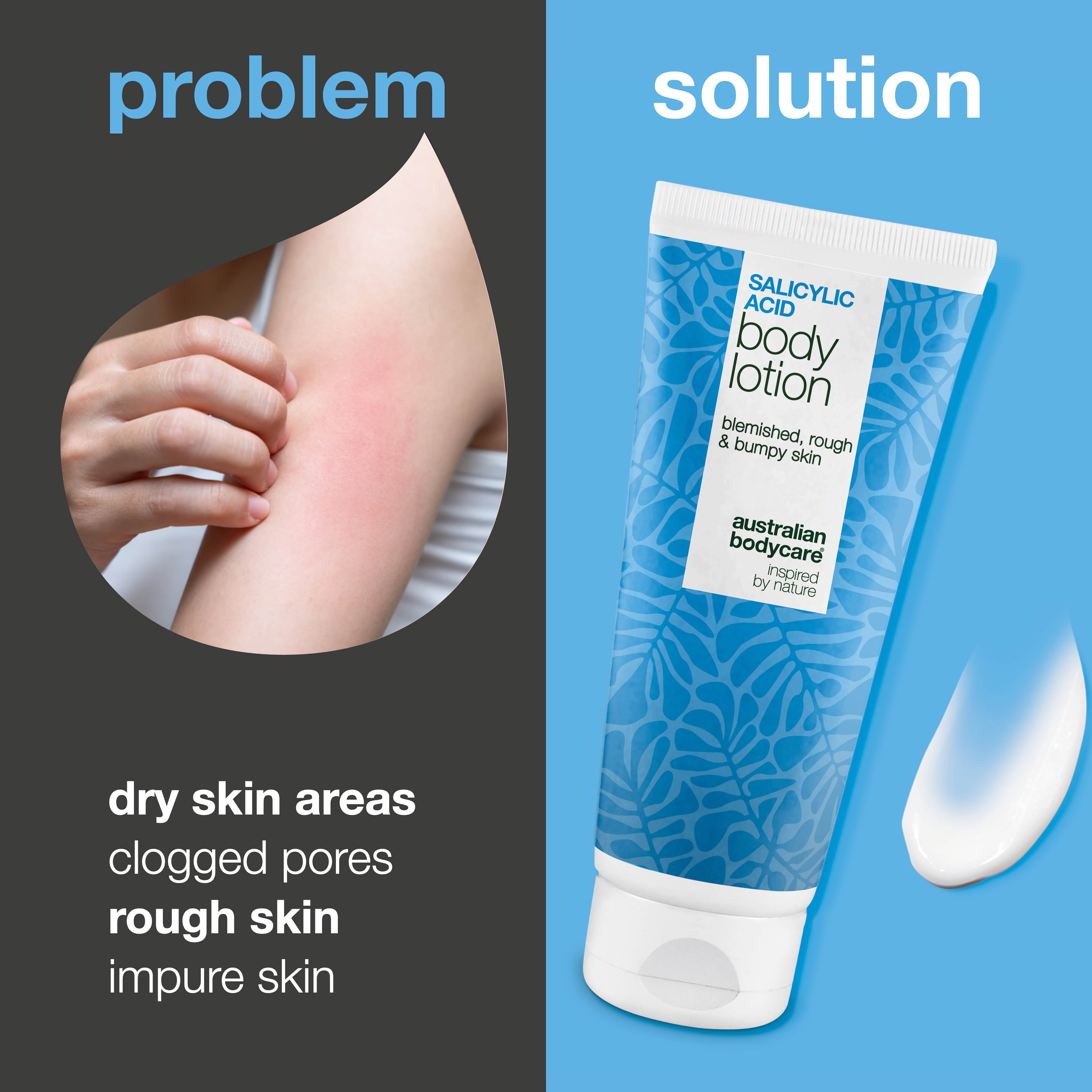 Salicylic asitli vücut losyonu, sivilceye eğilimli ve kuru ciltler için — nazikçe arındırır, nemlendirir, sivilce görünümünü ve pürüzlü, kuru cilt dokusunu azaltmaya yardımcı olur