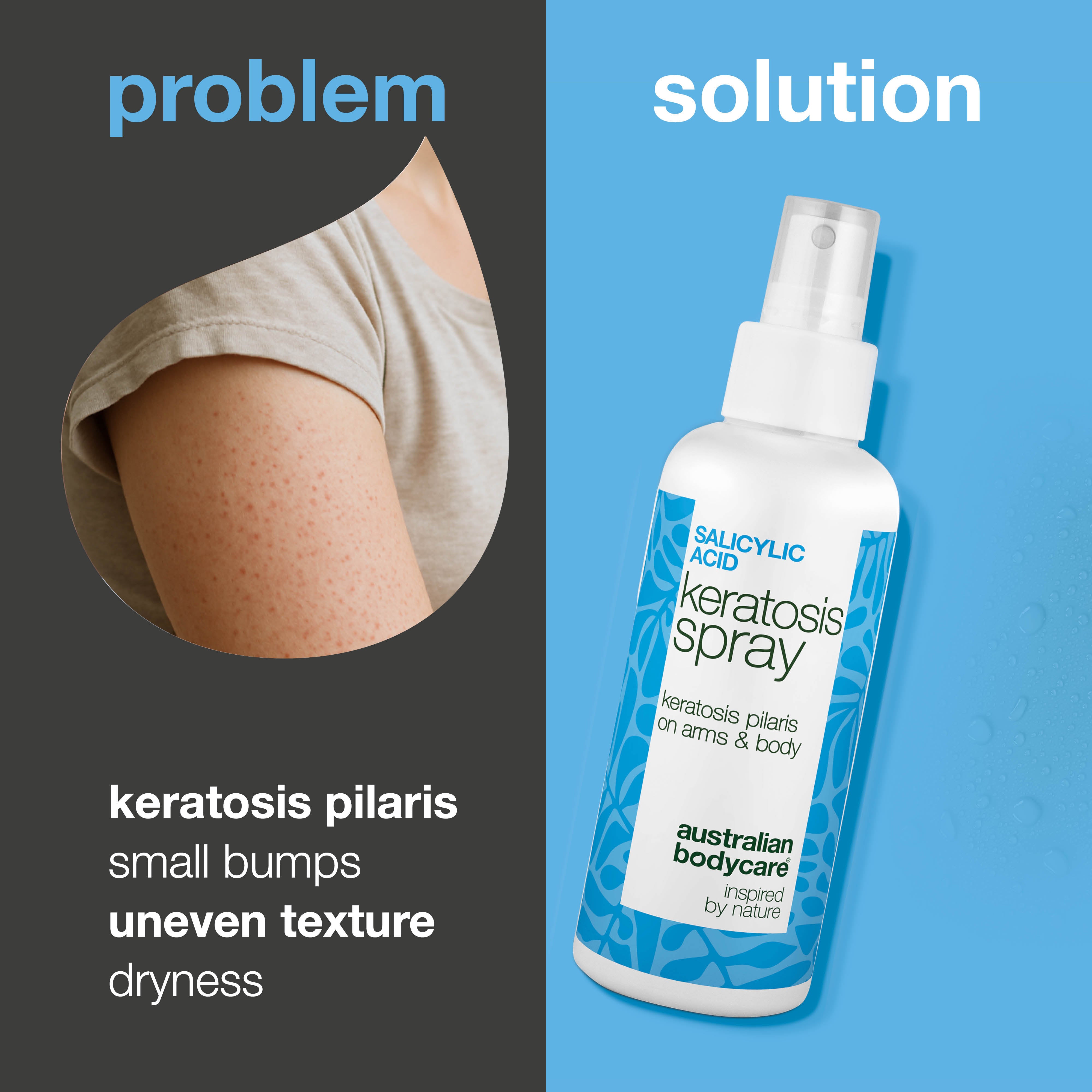 Salicylic asitli keratosis pilaris spreyi, pütürlü ve tavuk derisi görünümlü cilt için — Kollar ve bacaklardaki kuru, pütürlü kabarıklıkları azaltmaya, cildi nazikçe yumuşatmaya yardımcı olur