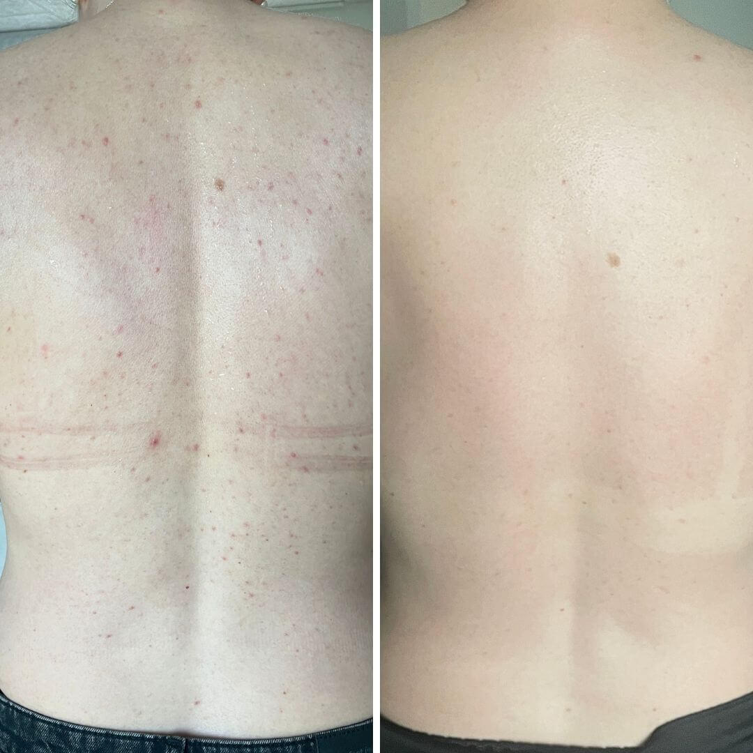 %2 Salisilik asit vücut spreyi, sivilceler ve tıkanmış gözenekler için — %2 salisilik asit ve glikolik asit içeren sprey, gözenekleri arındırmaya ve cildi pürüzsüzleştirmeye yardımcı olur