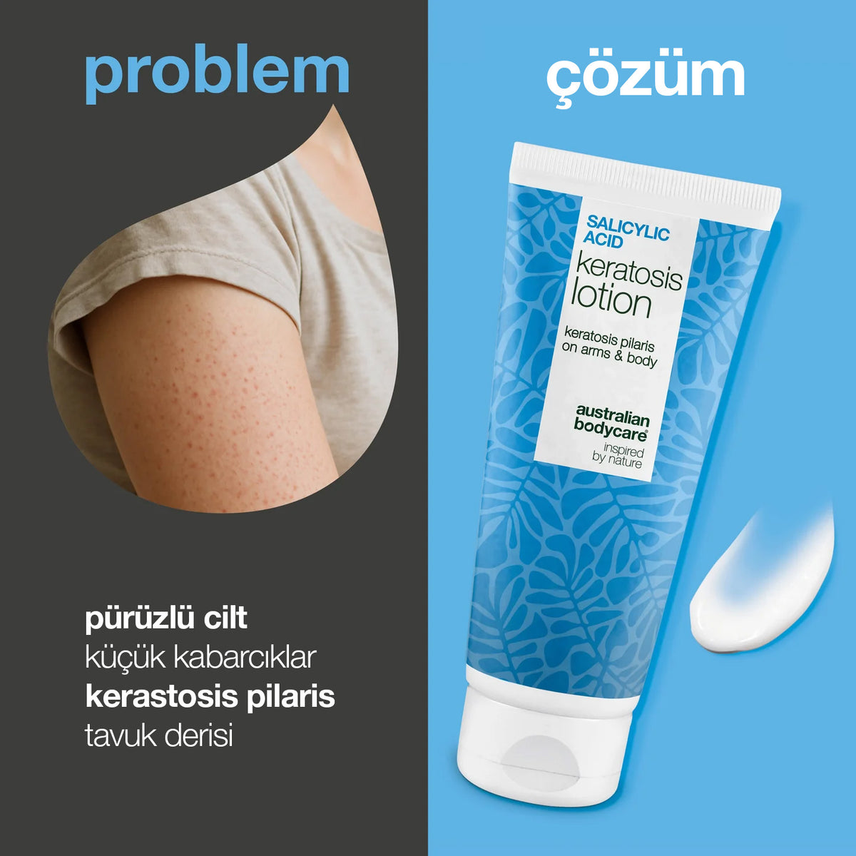 Salicylic Acid Kerastosis Lotion - Kerastosis Losyon
